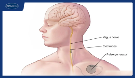 部脑刺激（DBS）导线核心材料：铂铱合金线与MP35N电线图示